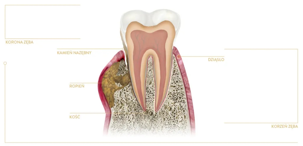 Jak przebić ropień na dziąśle i uniknąć poważnych komplikacji