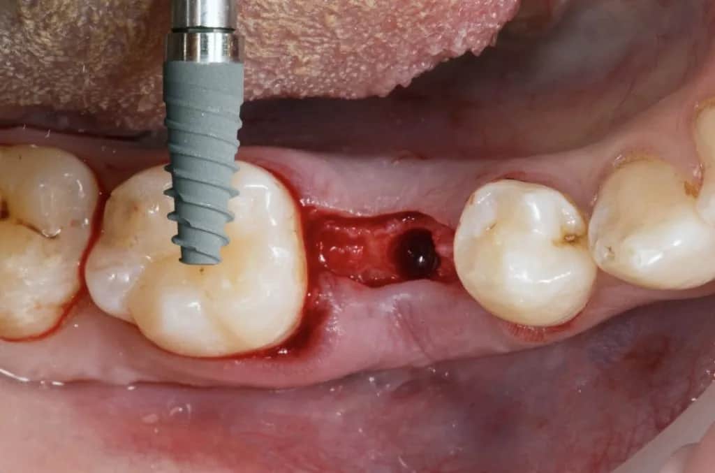 Kiedy implant po wyrwaniu zęba? Poznaj kluczowe terminy i ryzyka