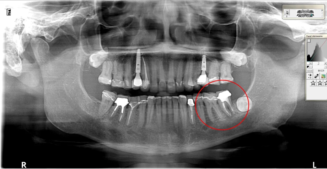 Pionowe pęknięcie korzenia zęba objawy – jak je rozpoznać i leczyć