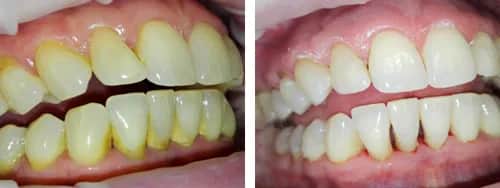 Czy piaskowanie wybiela zęby? Poznaj prawdę o tej metodzie