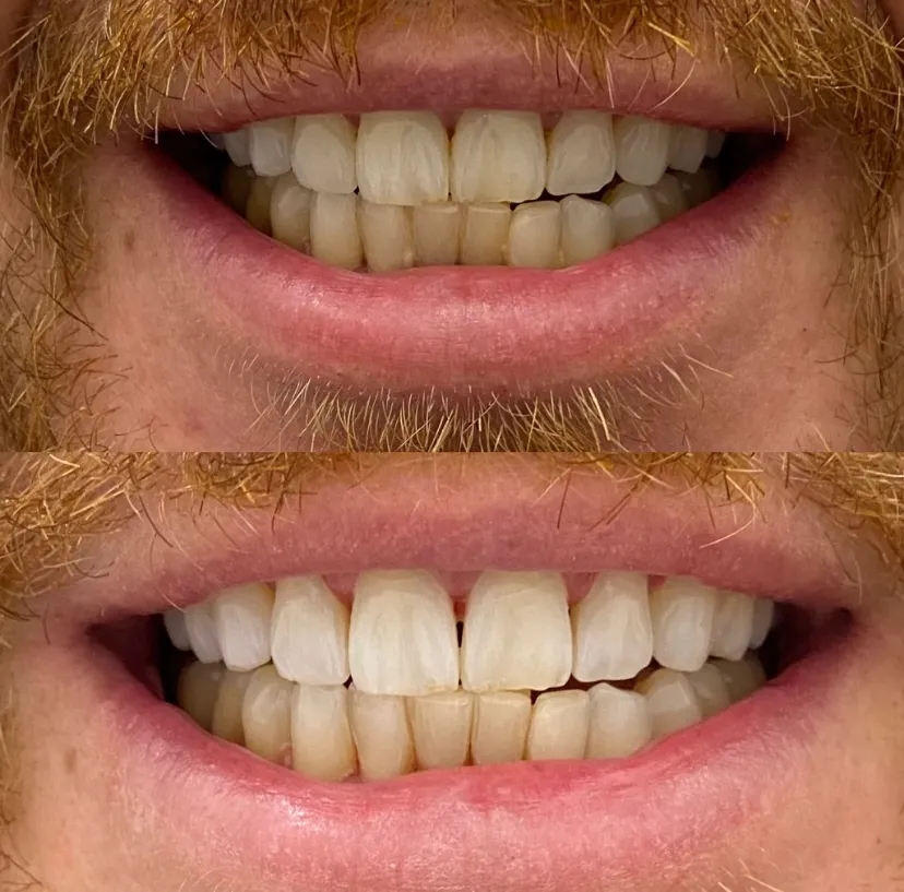 Jak wybielić zęby u dentysty - skuteczne metody i ich efekty