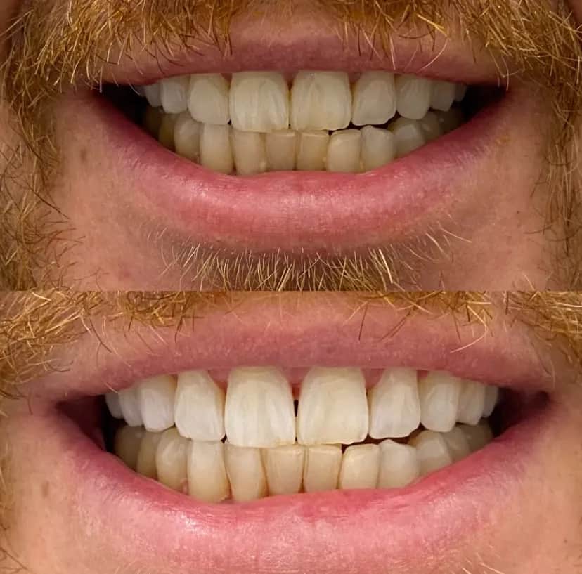 Jak wybielić zęby u dentysty - skuteczne metody i ich efekty