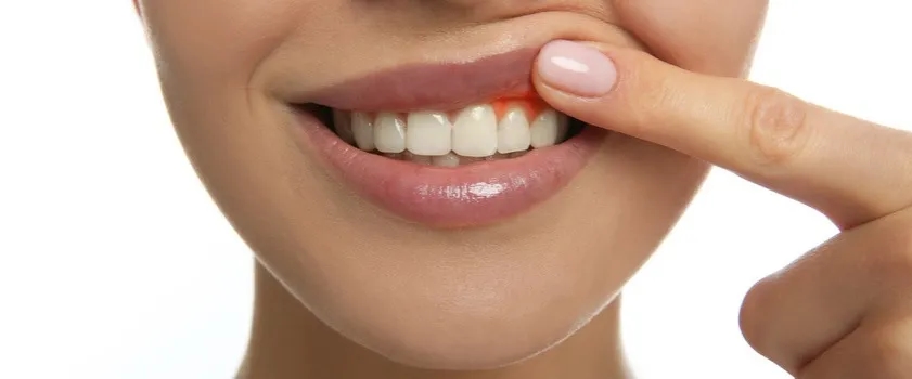 Co na dziąsła w ciąży? Jak uniknąć bólu i zapalenia dziąseł