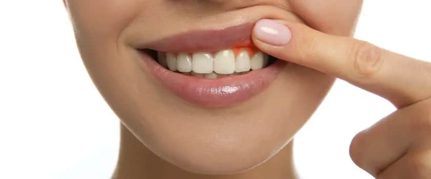 Co na dziąsła w ciąży? Jak uniknąć bólu i zapalenia dziąseł