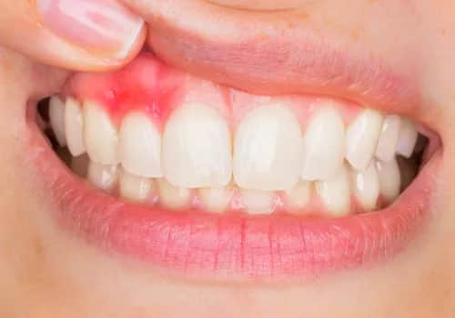 Jak wygląda zapalenie dziąseł? Objawy, które mogą cię zaskoczyć