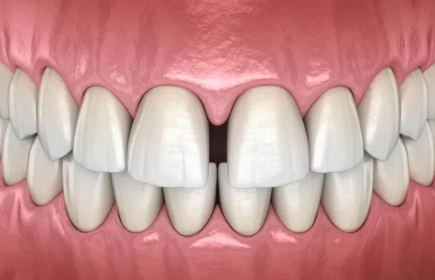 Szpara między zębami jak się nazywa? Poznaj diastemę i jej znaczenie
