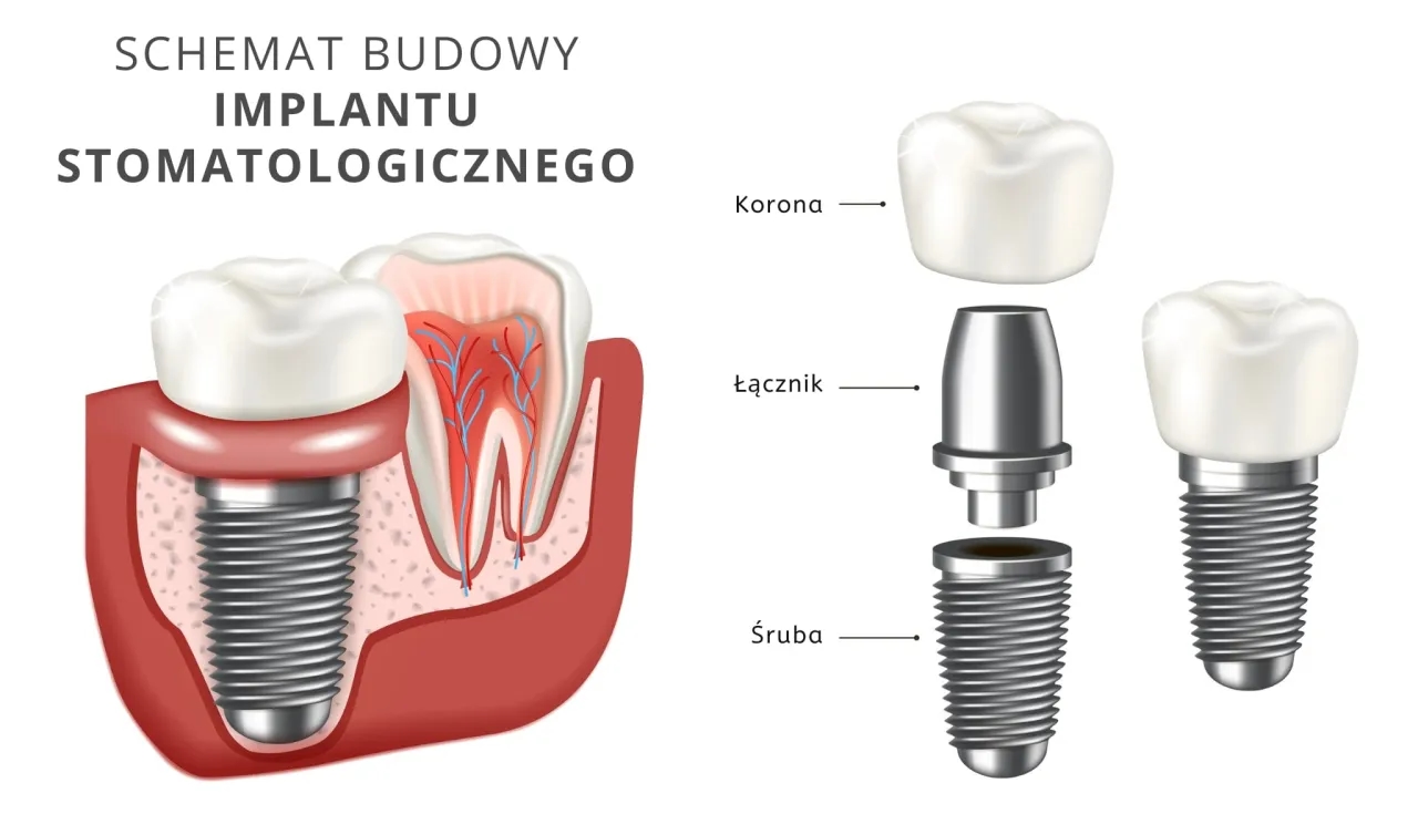 Ile kosztuje wstawienie sztucznego zęba? Sprawdź ukryte wydatki