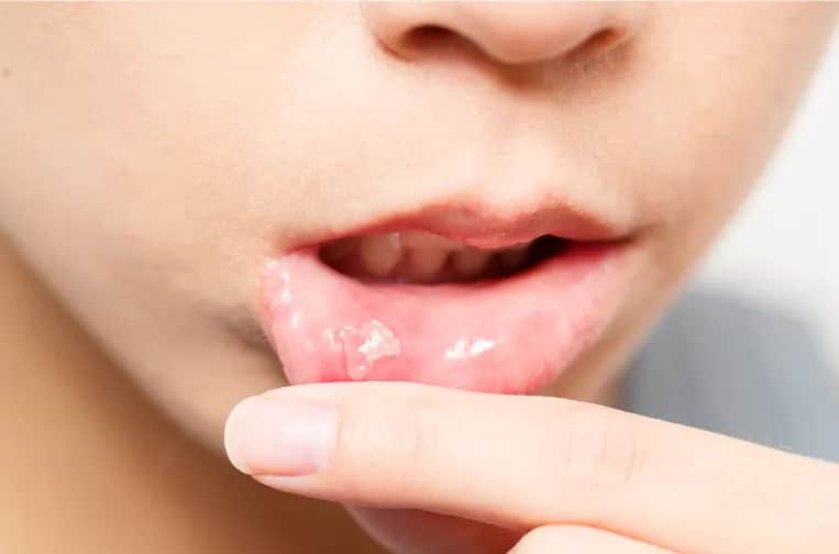 Skuteczne sposoby na smarowanie nadżerek w jamie ustnej, które przynoszą ulgę