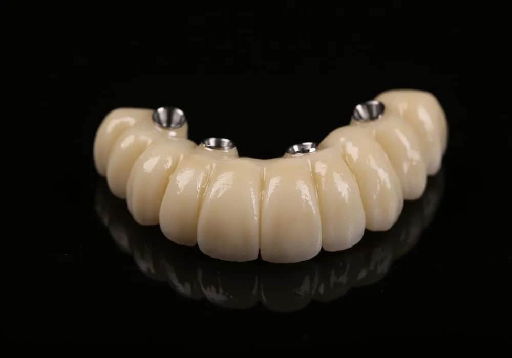 Ile kosztuje implant zęba? Sprawdź ceny i ukryte wydatki