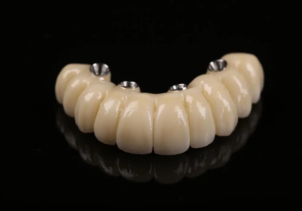 Ile kosztuje implant zęba? Sprawdź ceny i ukryte wydatki