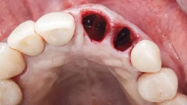 Jak powinna wyglądać dziura po wyrwaniu zęba - co jest normalne?
