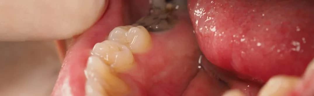 Jak długo wytrzymuje ząb leczony kanałowo? Fakty, które musisz znać