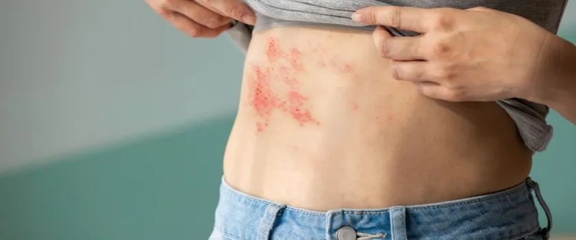 Jak długo brać leki na półpasiec, aby uniknąć powikłań?