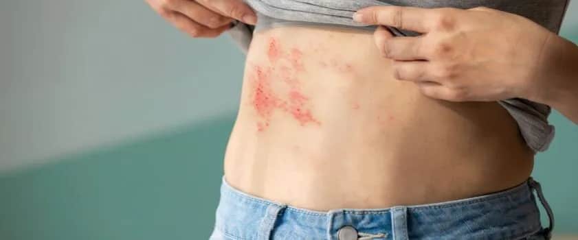 Jak długo brać leki na półpasiec, aby uniknąć powikłań?