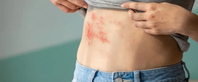 Jak długo brać leki na półpasiec, aby uniknąć powikłań?