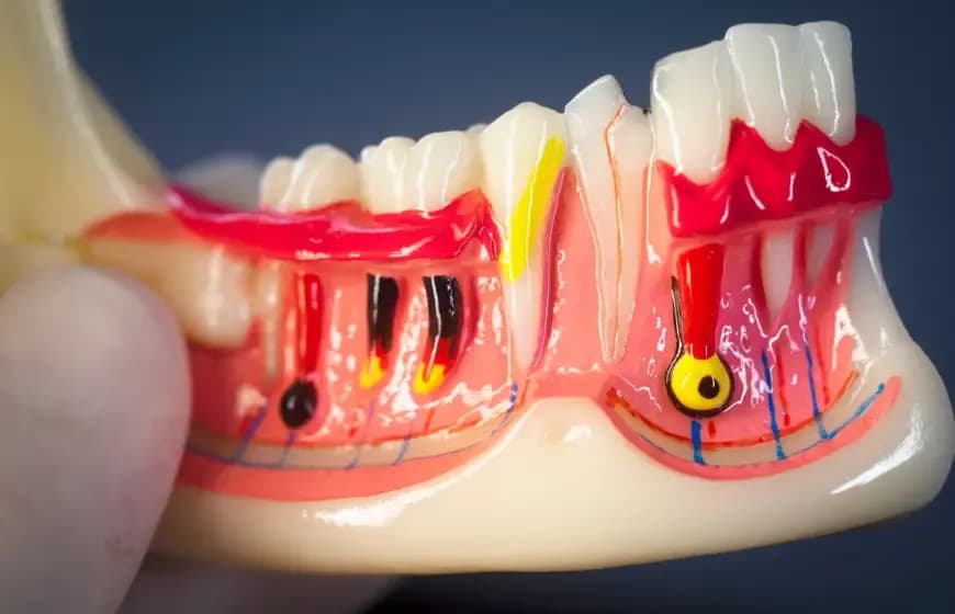 Dlaczego bolą zęby? Odkryj przyczyny i skuteczne leczenie bólu