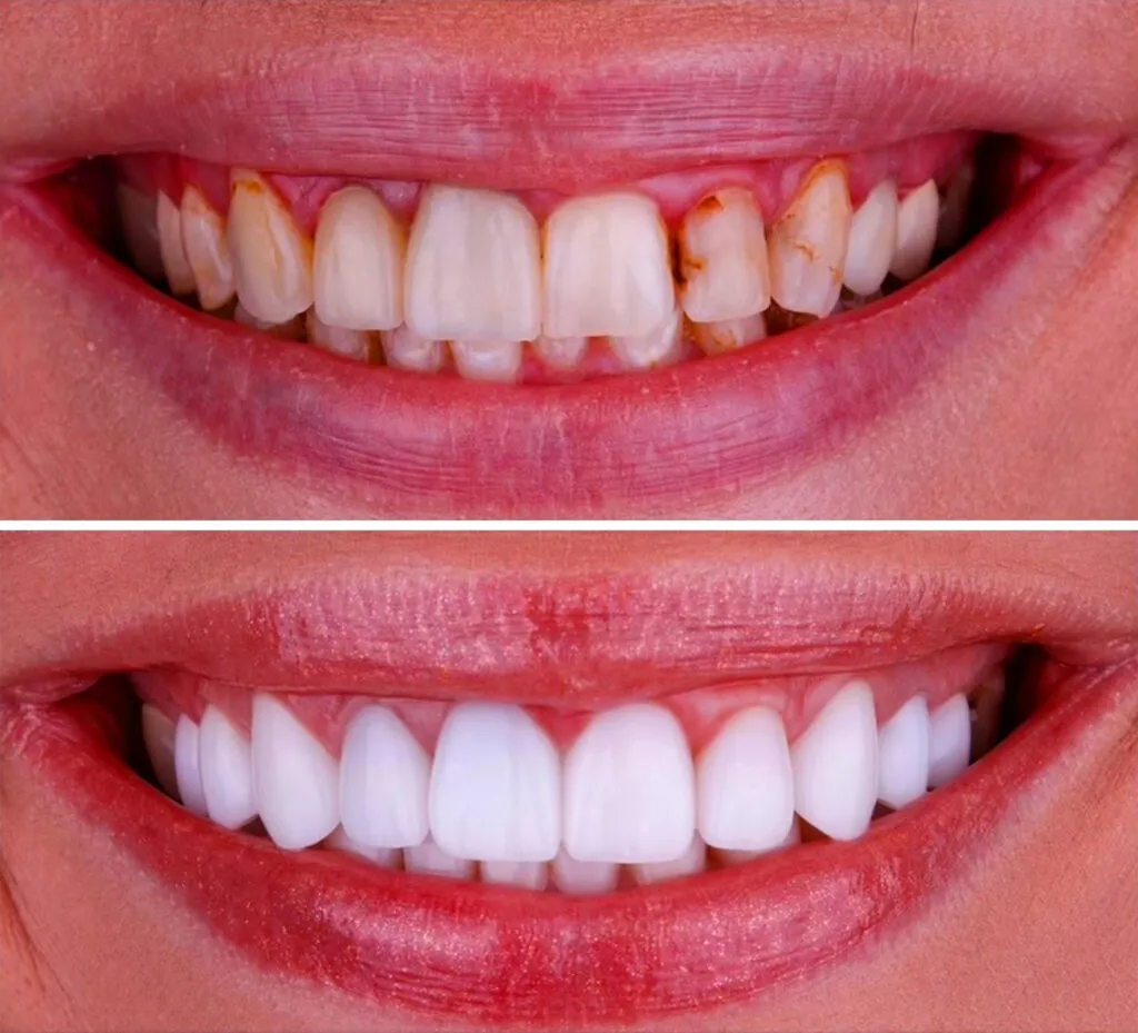 Czym wypełnić ubytek w zębie? Poznaj najlepsze materiały i ich zalety